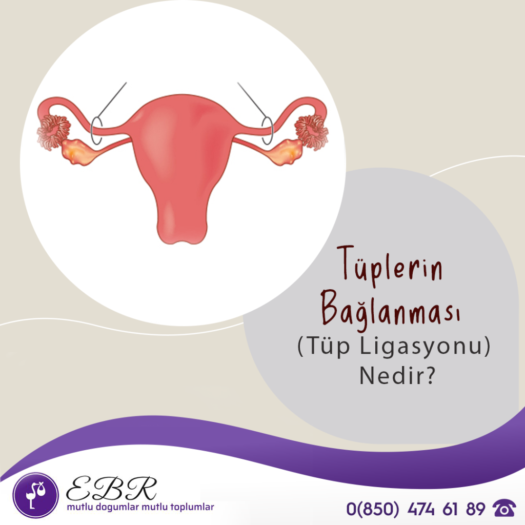 Tüplerin Bağlanması (Tüp Ligasyonu) Nedir?